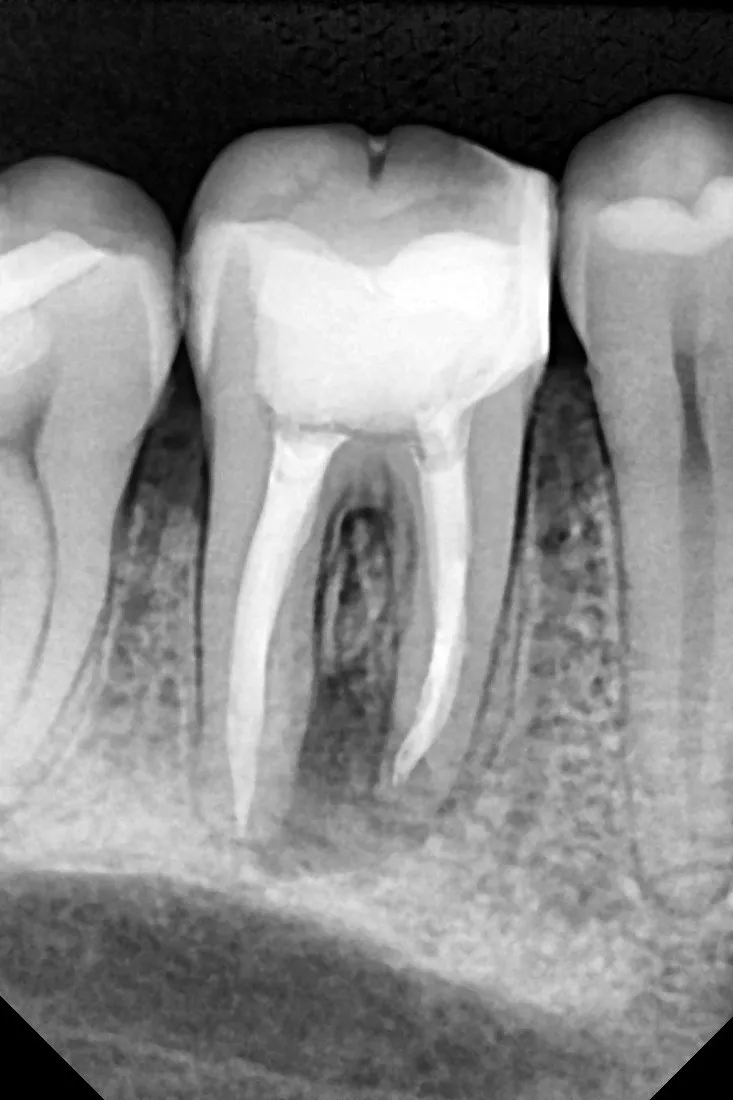 2.a - Radiografie de control imediat după finalizarea retratamentului - ortoradial