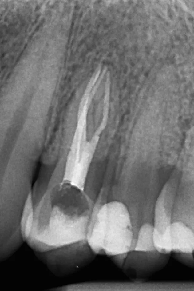 2.b - radiografie de control după finalizarea tratamentului la nivelul dintelui 2.4 - incidență distală