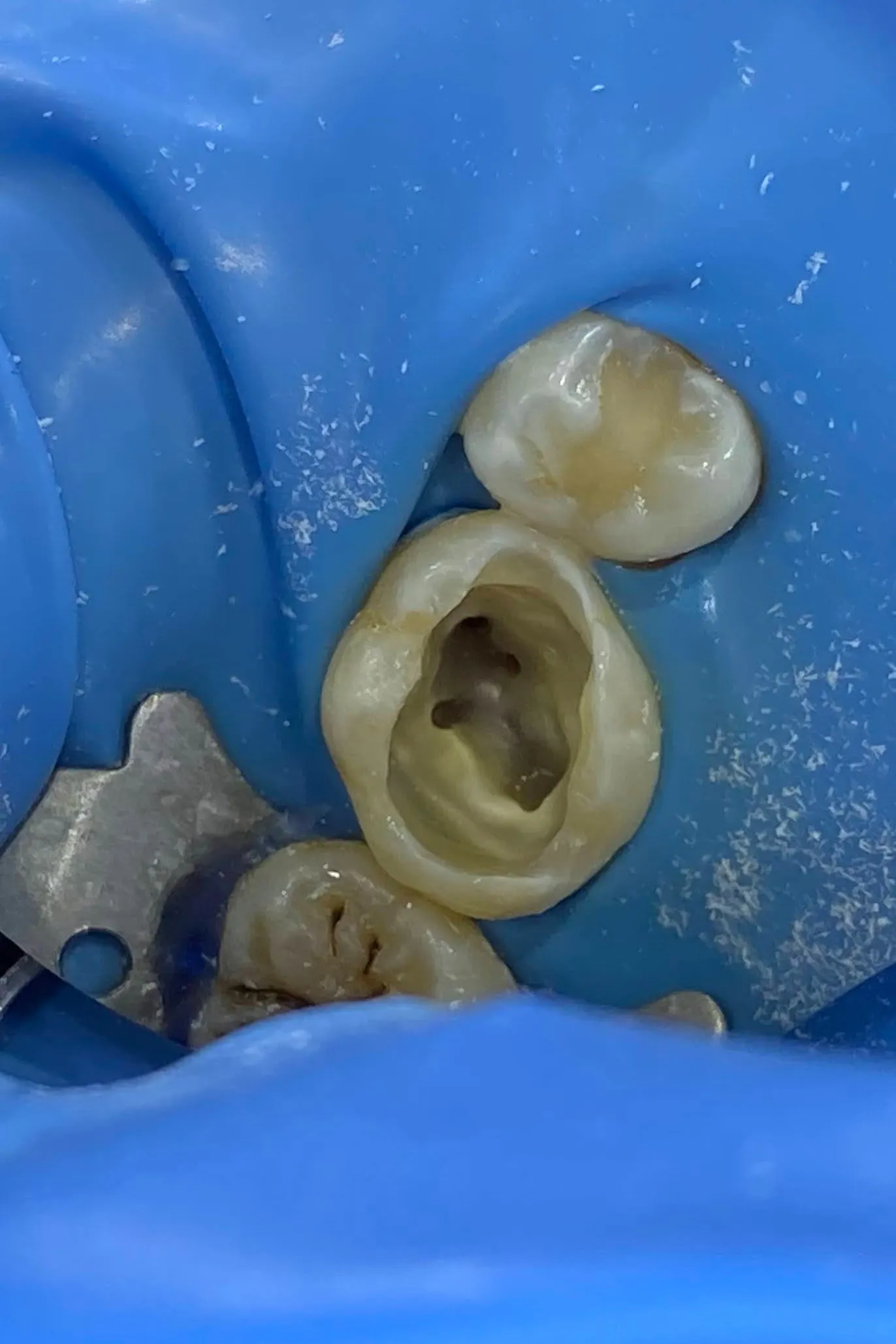 2 - aspect în timpul tratamentului endodontic - secreție purulentă abundentă canal Palatinal