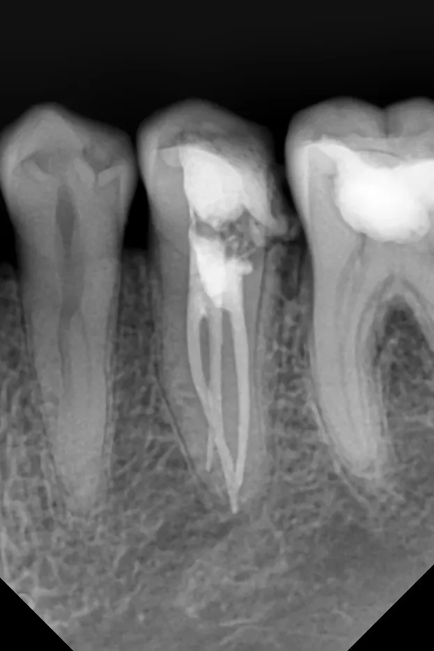 2.a - radiografie de control imediat după tratamentul endodontic - ortoradial