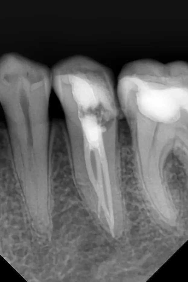2.b - radiografie de control imediat după tratamentul endodontic - incidență mezială