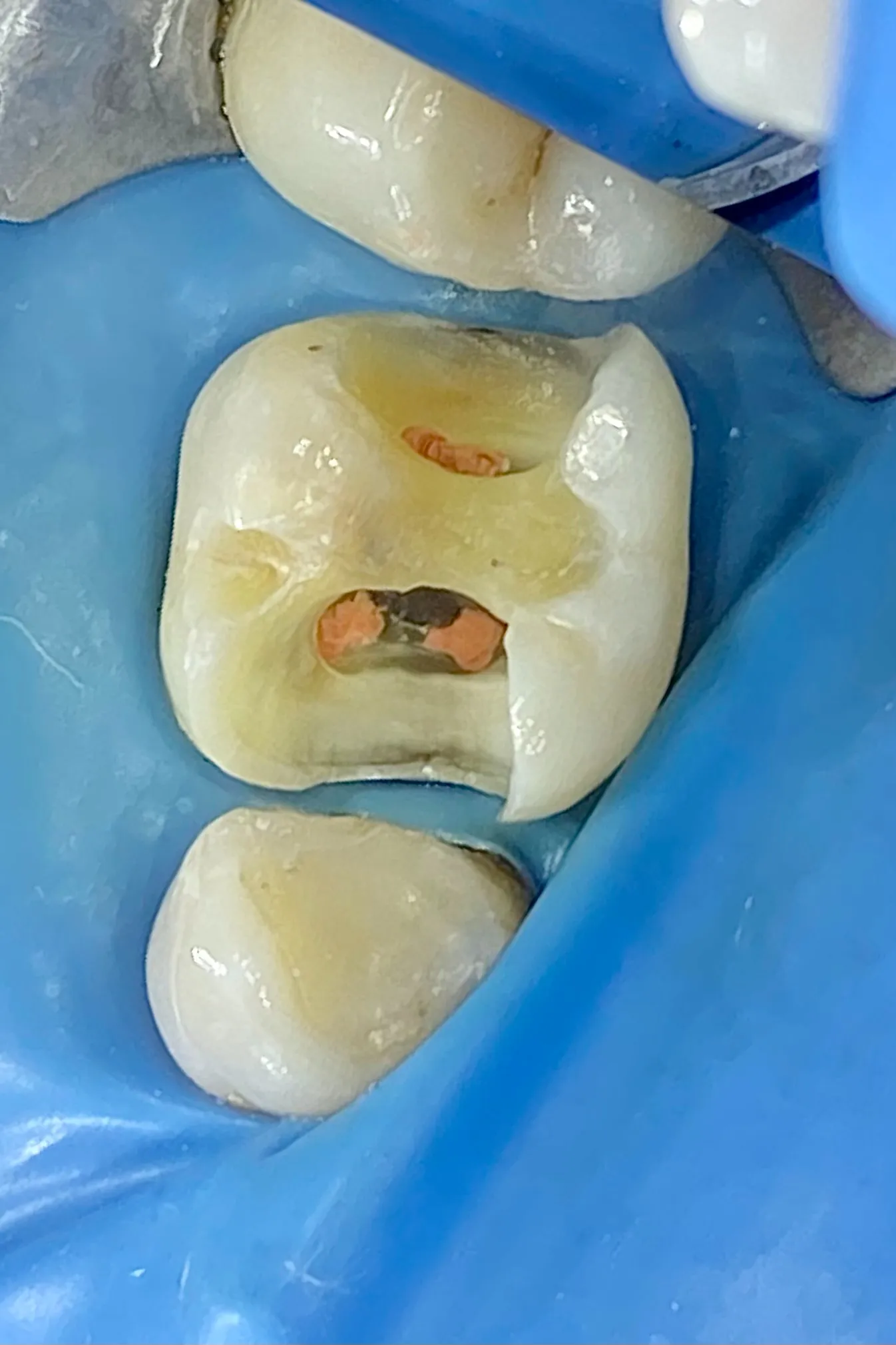 2b. Aspect după finalizarea tratamentului endodontic