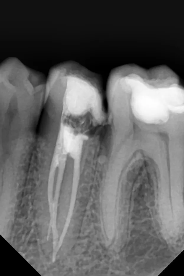 2.c - radiografie de control imediat după tratamentul endodontic - incidență distală