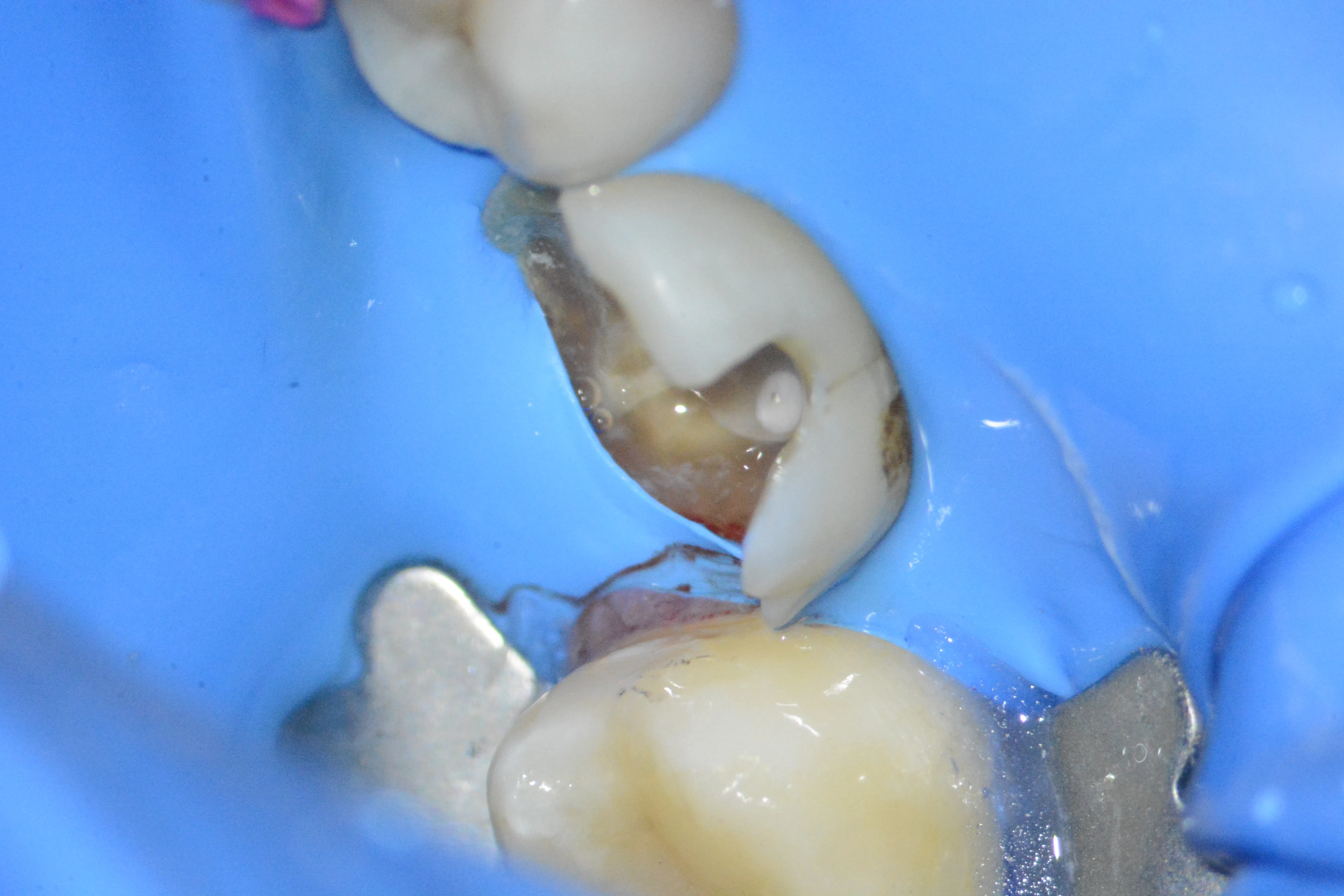 3 – Izolare deficitară