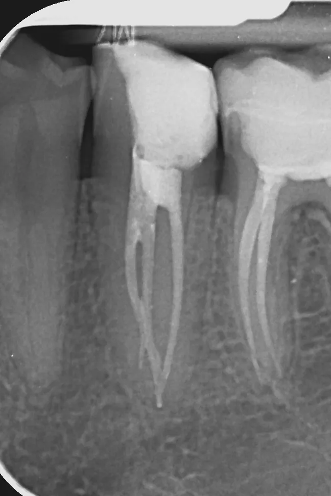 3 - radiografie de control la 6 luni de la finalizarea tratamentului endodontic - ortoradial