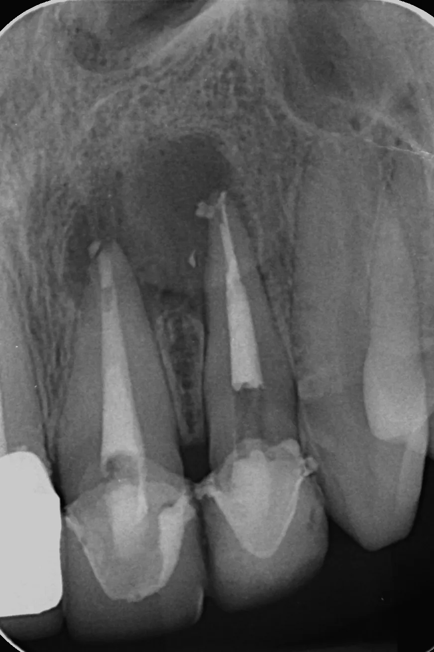 3 - Radiografie de control la finalizarea retratamentelor endodontice
