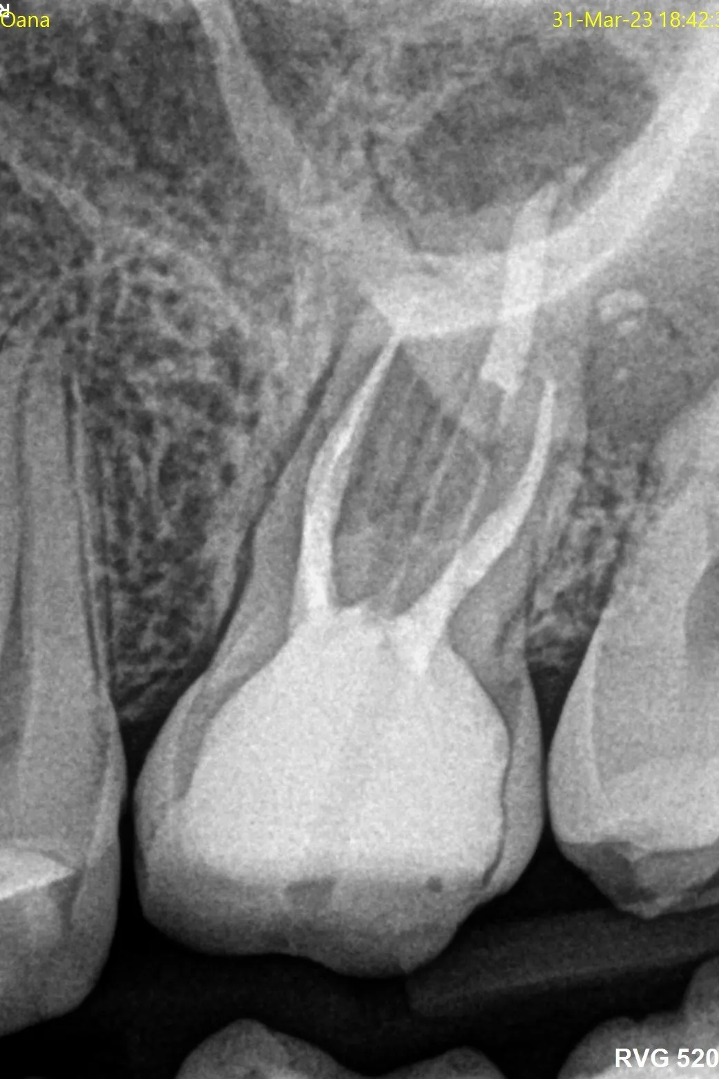 3- radiografia de control imediat după finalizarea tratamentului endodontic - compactare MTA apical și reconstrucție corono-radiculară