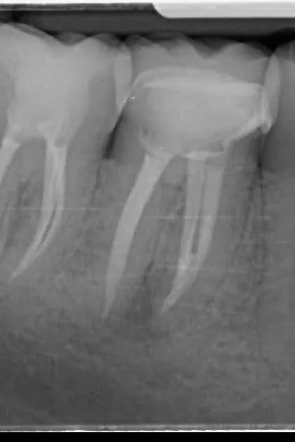 3 - Radiografie de control la 6 luni de la finalizarea retratamentului - leziune periapicală în proces de vindecare