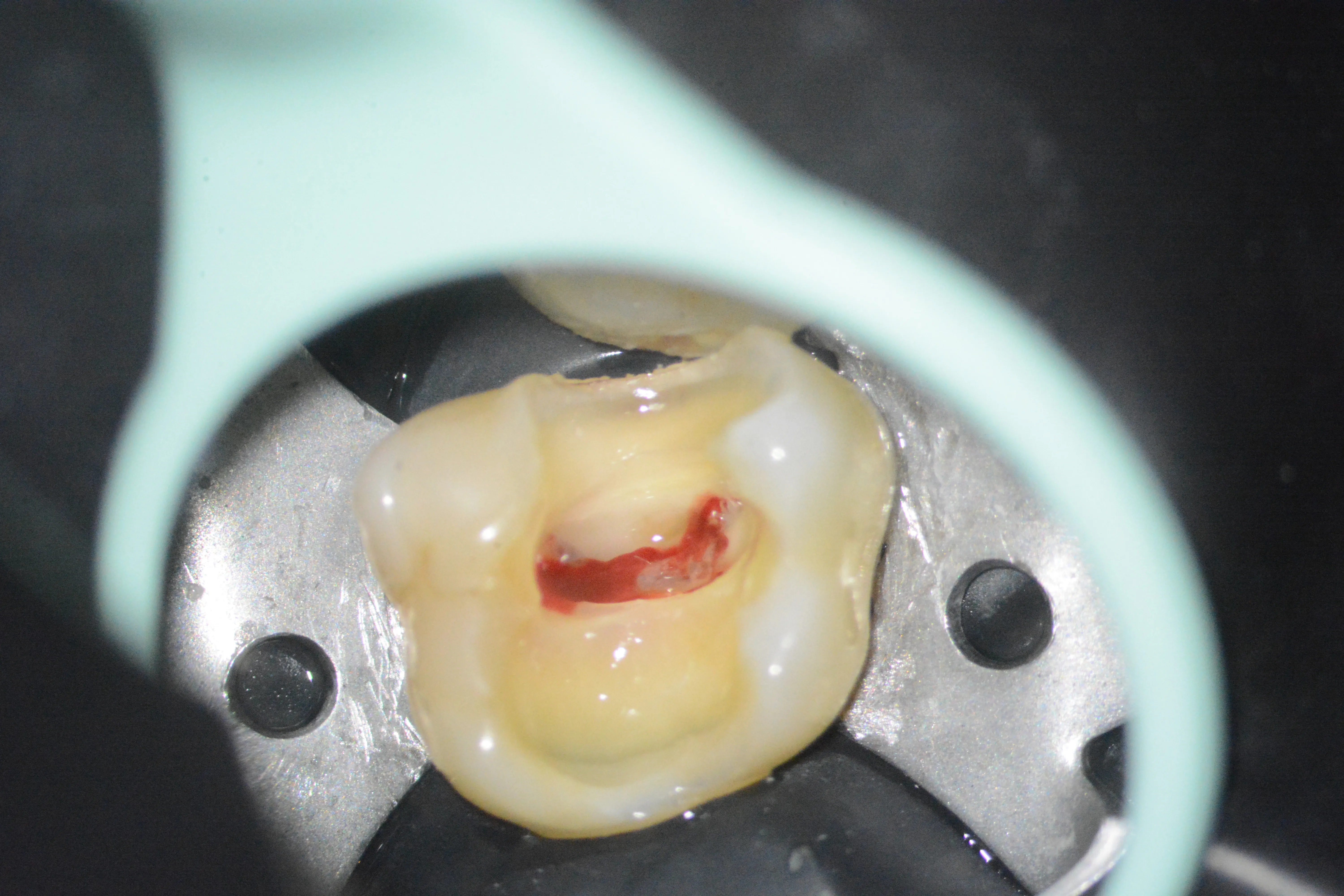 3 – Aspectul pulpei coronare