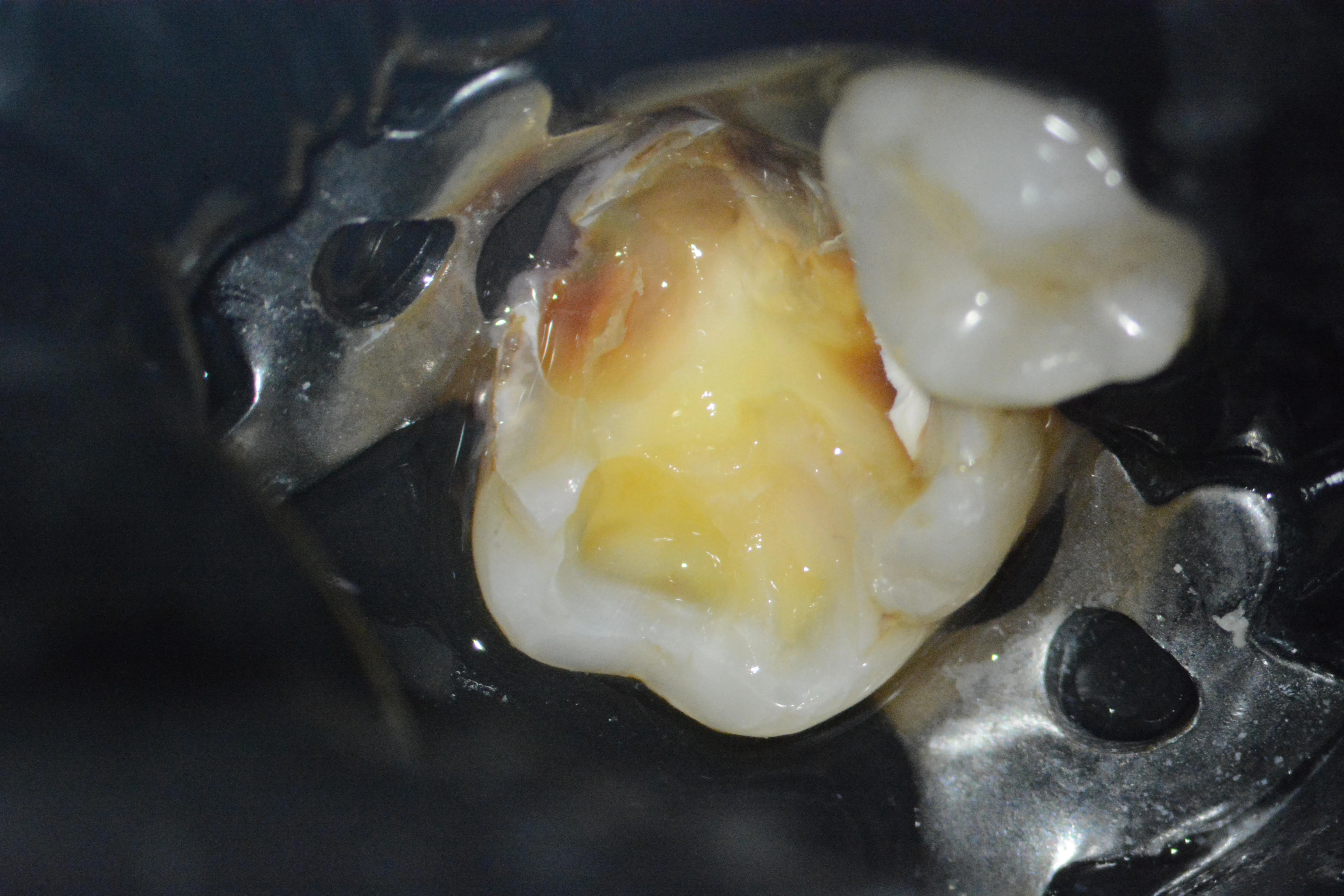 3 – Exereză parțială dentină alterată