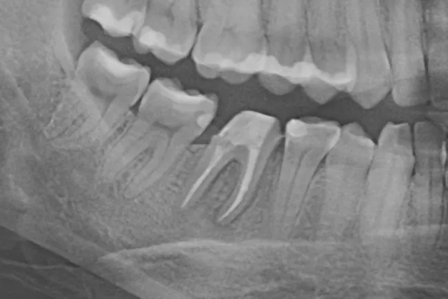 3 - Radiografie de control la 6 luni de la tratament. Leziune periapicală în decurs de vindecare. Restaurare protetică provizorie realizată în laborator