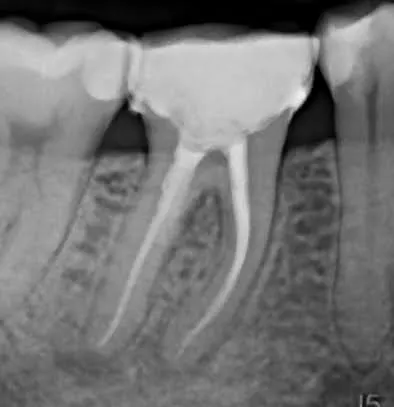 3.a - Radiografie de control la 6 luni de la finalizarea tratamentului endodontic si a reparației perforației cu MTA - vindecarea ambelor leziuni - ortoradial