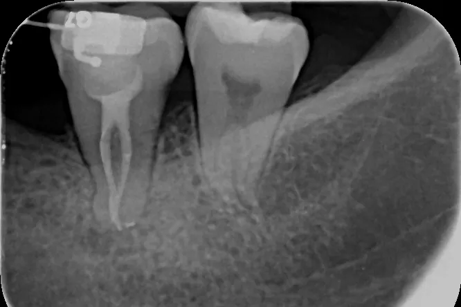 3a - Radiografie de control imediat după terminarea tratamentului - ortoradial