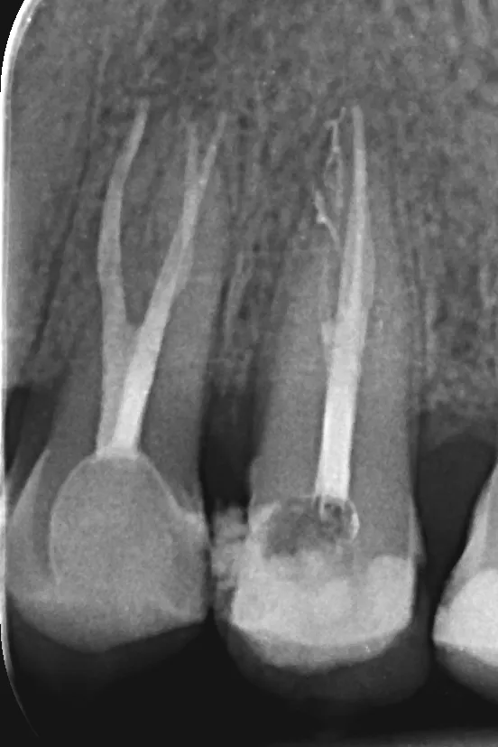 3.a - radiografie de control la 3 luni de la finalizarea tratamentului la nivelul dintelui 2.4, și imediat după finalizarea tratamentului la nivelul dintelui 2.5 - ortoradial
