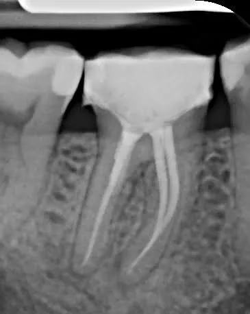 3.b - Radiografie de control la 6 luni de la finalizarea tratamentului endodontic si a reparației perforației cu MTA - vindecarea ambelor leziuni - incidență mezială
