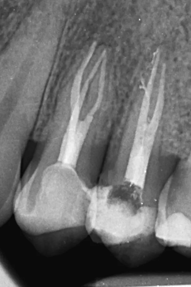 3.b - radiografie de control la 3 luni de la finalizarea tratamentului la nivelul dintelui 2.4, și imediat după finalizarea tratamentului la nivelul dintelui 2.5 - incidență distală