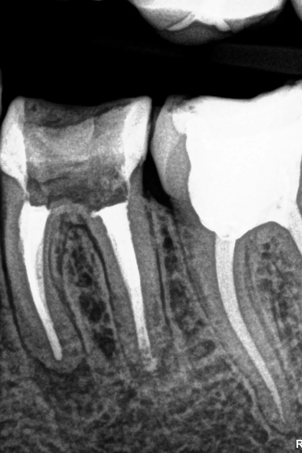3 - radiografie de control - 3.6 - canal distal obturat prin condensare apicală MTA și injectare gutapercă