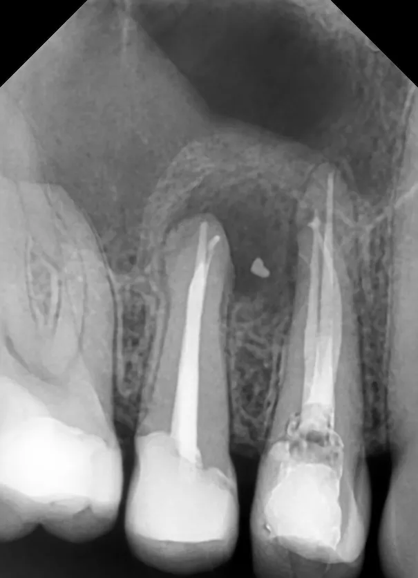 3a. Radiografie de control dupa finalizarea retratamentului endodontic la nivelul primului premolar superior, la aproximativ 2 saptămâni de la primul tratament, incidență ortoradială