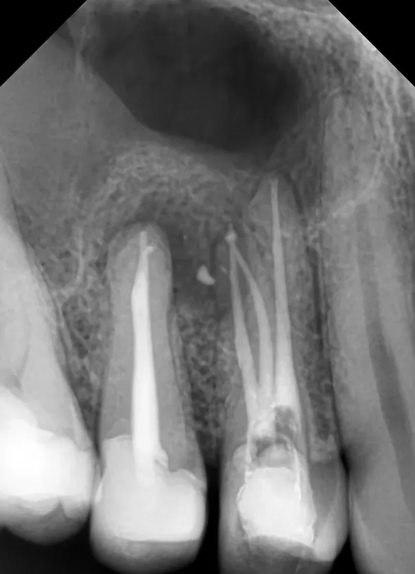 3b. Radiografie de control dupa finalizarea retratamentului endodontic la nivelul primului premolar superior, la aproximativ 2 saptămâni de la primul tratament, incidență mezială