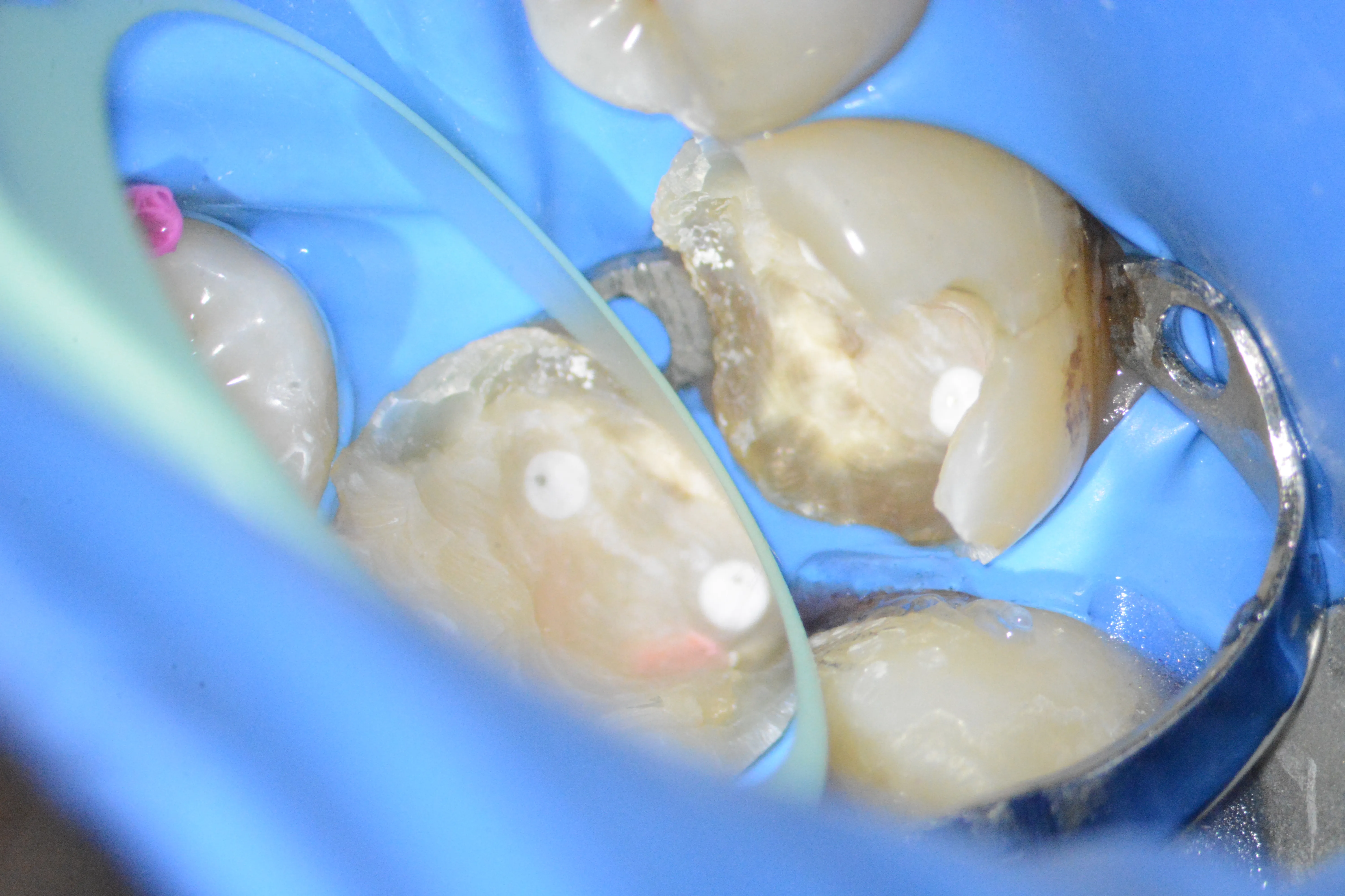 4 – Aplicare clemă de digă accesorie