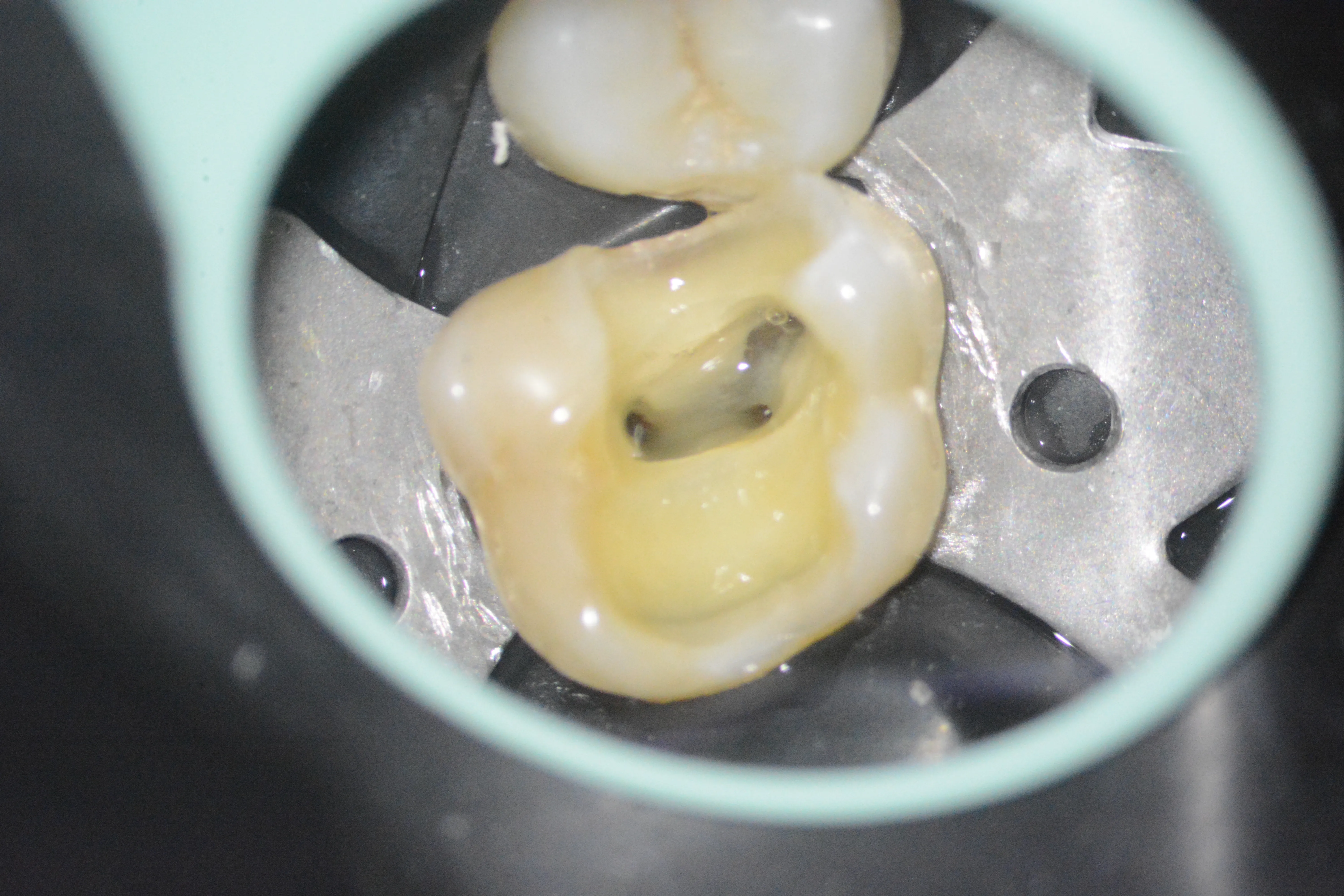 4 – Tratament mecanico-antiseptic