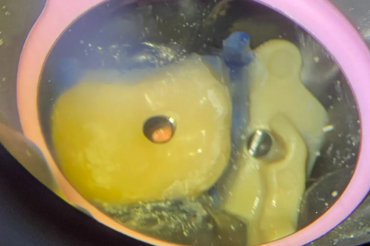 4 - Canalul distal obturat