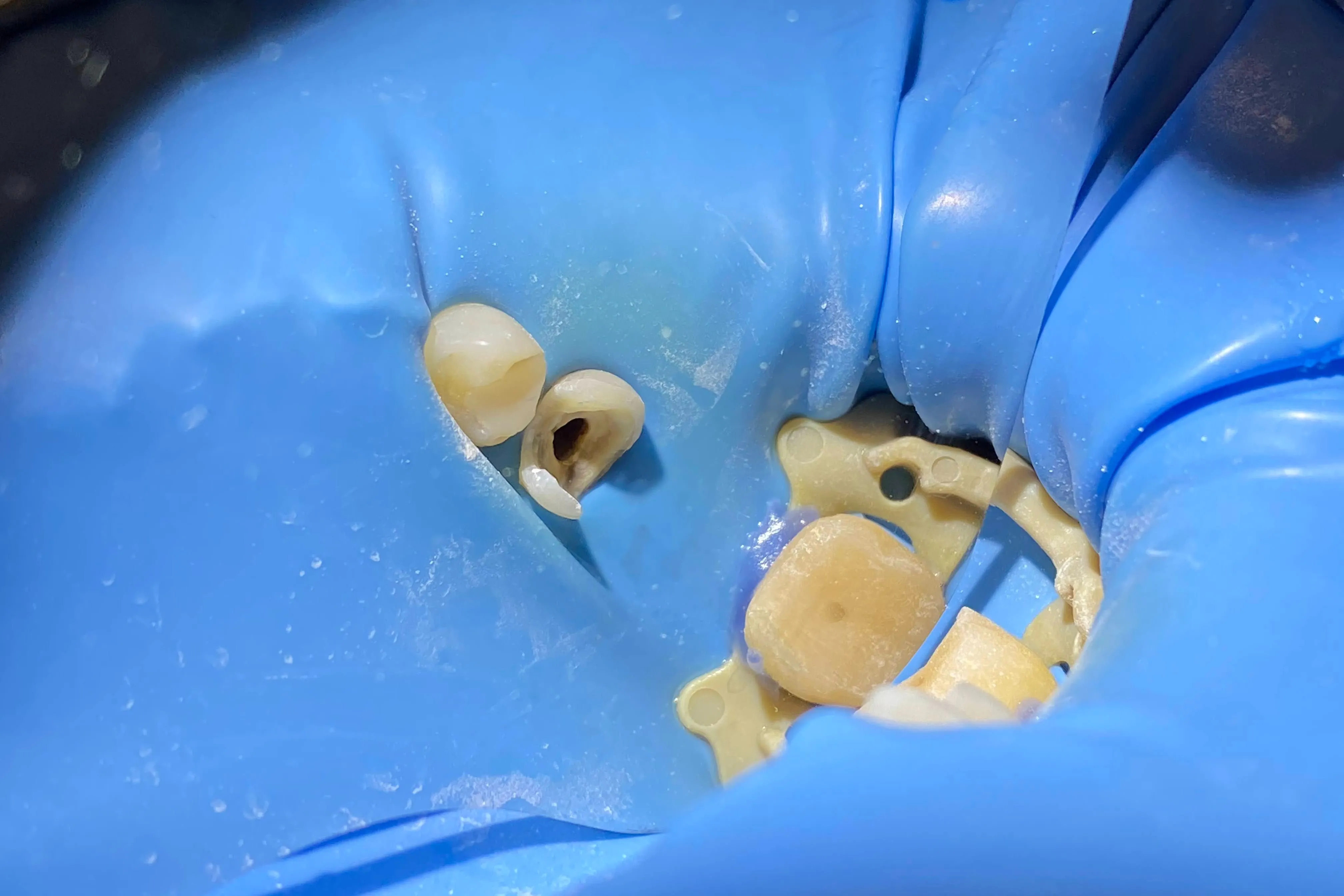 4 - Aspectul final al reconstrucției corono-radiculare 3.7 | În timpul tratamentului endodontic 3.5: îndepărtarea țesuturilor alterate, retratament mecanico-antiseptic finalizat, canal uscat pregătit pentru obturare
