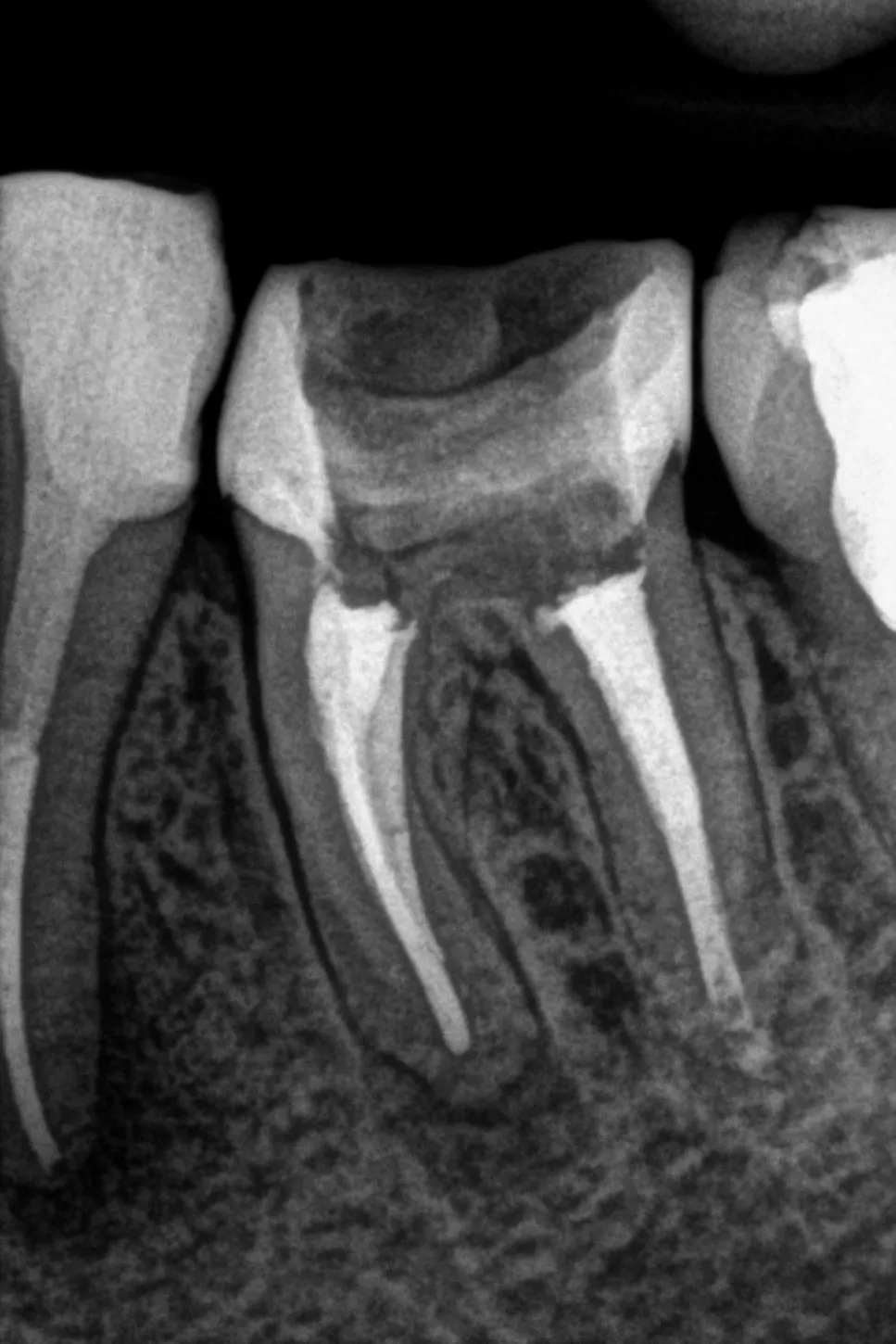4 - radiografie de control după finalizarea tratamentelor  - incidență mezială