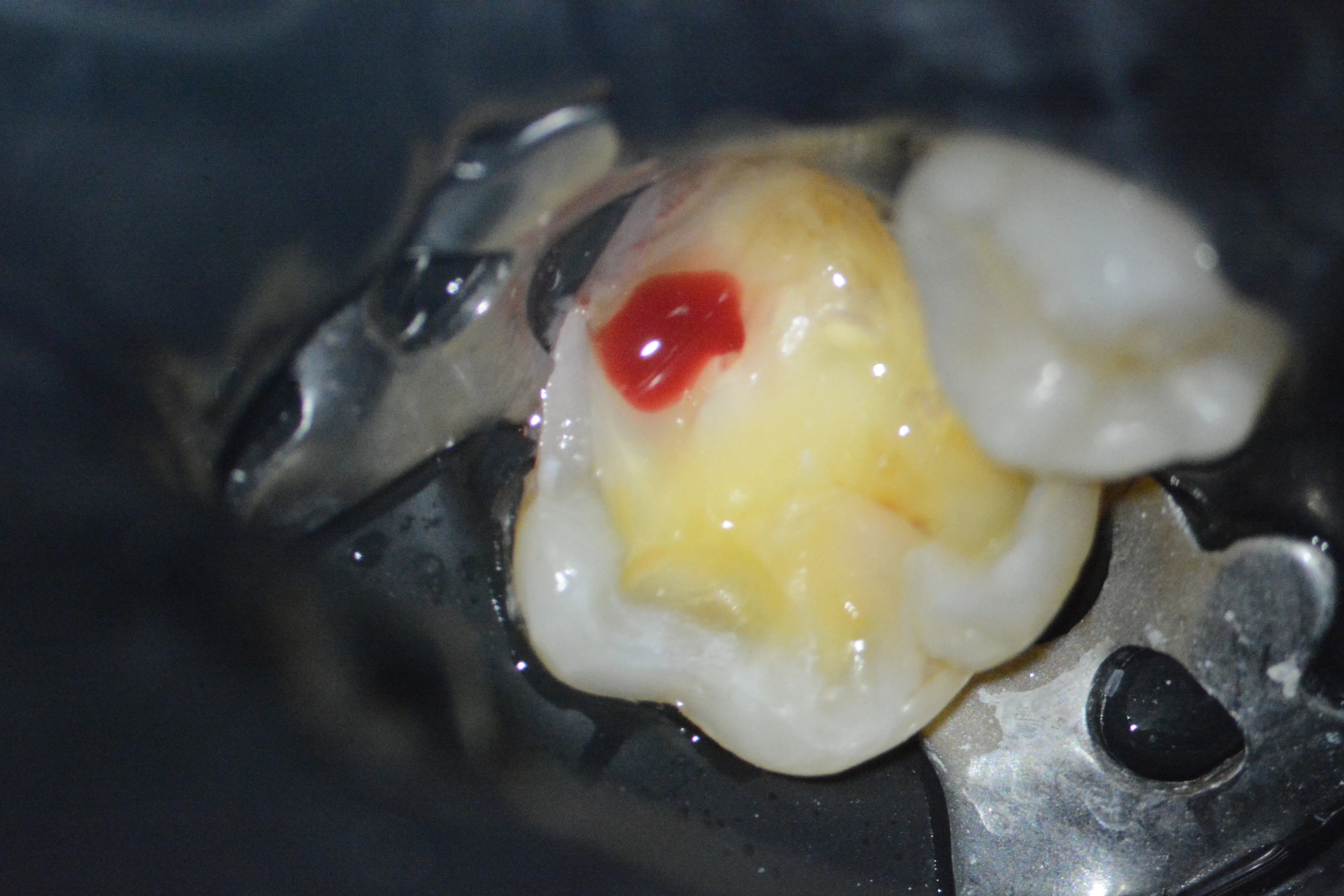 4 – Inflamație pulpară ireversibilă