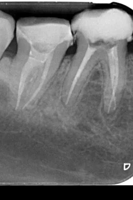 4 - radiografie de control imediat după finalizarea tratamentelor