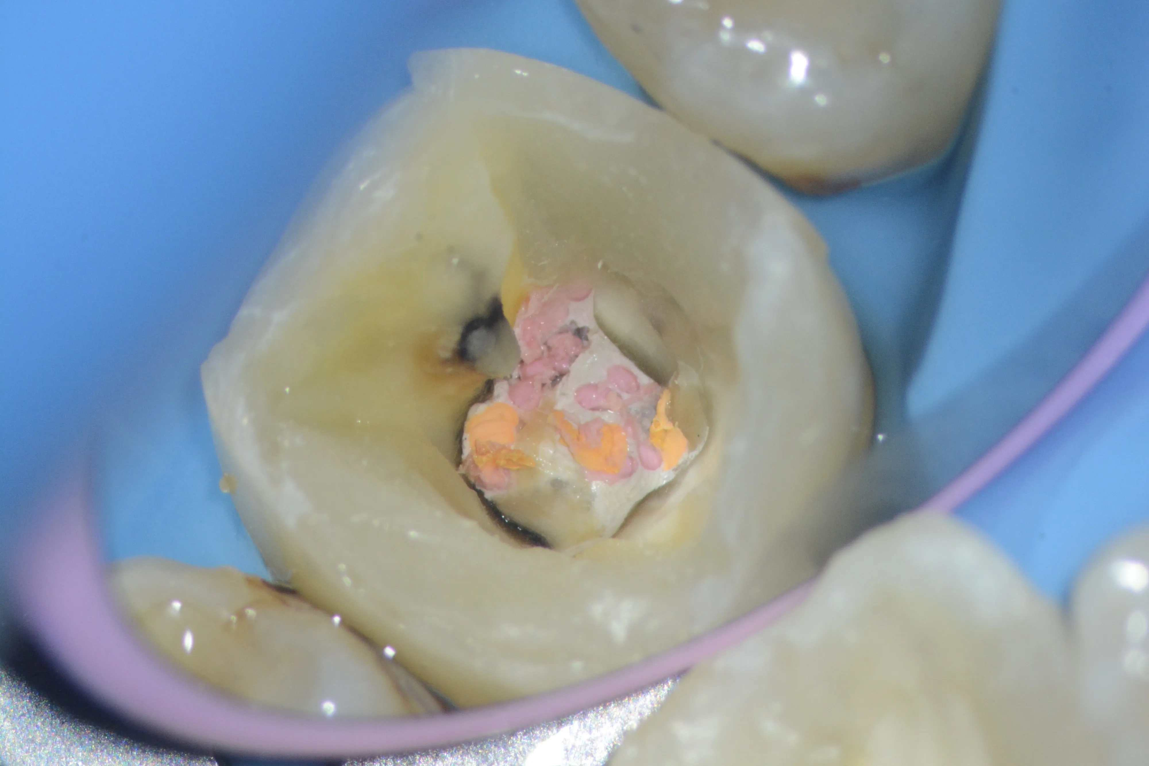 4 - Clinic în urma îndepărtării proceselor carioase si a obturație - după realizarea reconstrucției preendodontice