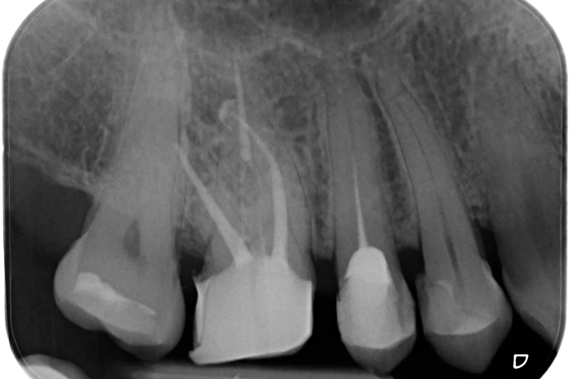 4 - Radiografia de control după finalizarea retratamentului și a reconstrucției