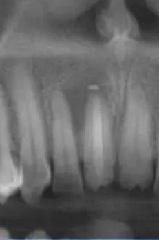 aspectul leziunii la 6 luni de la finalizarea tratamentului endodontic - leziune micșorată, în proces de vindecare