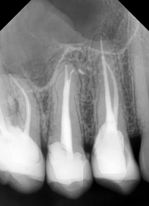 4a. Radiografie de control la 6 luni de la finalizarea tratamentelor - leziune periapicală complet vindecată - incidență ortoradială