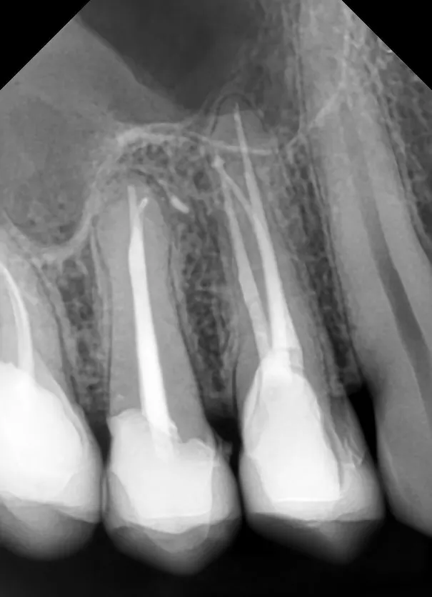 4b. Radiografie de control la 6 luni de la finalizarea tratamentelor - leziune periapicală complet vindecată, incidență mezială