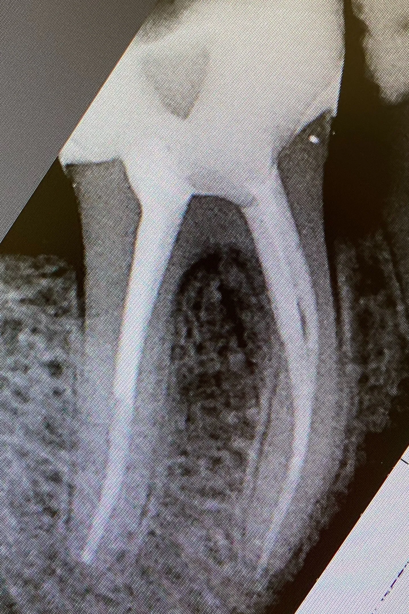 5. Radiografia de control imediat după finalizarea tratamentului endodontic