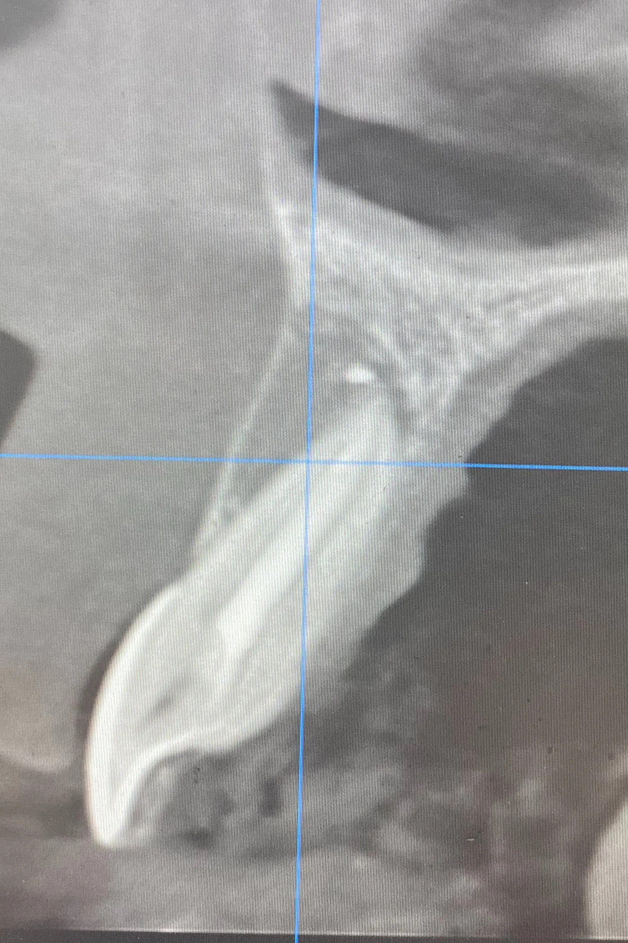 aspectul leziunii la 6 luni de la finalizarea tratamentului endodontic - secțiune sagitală CBCT