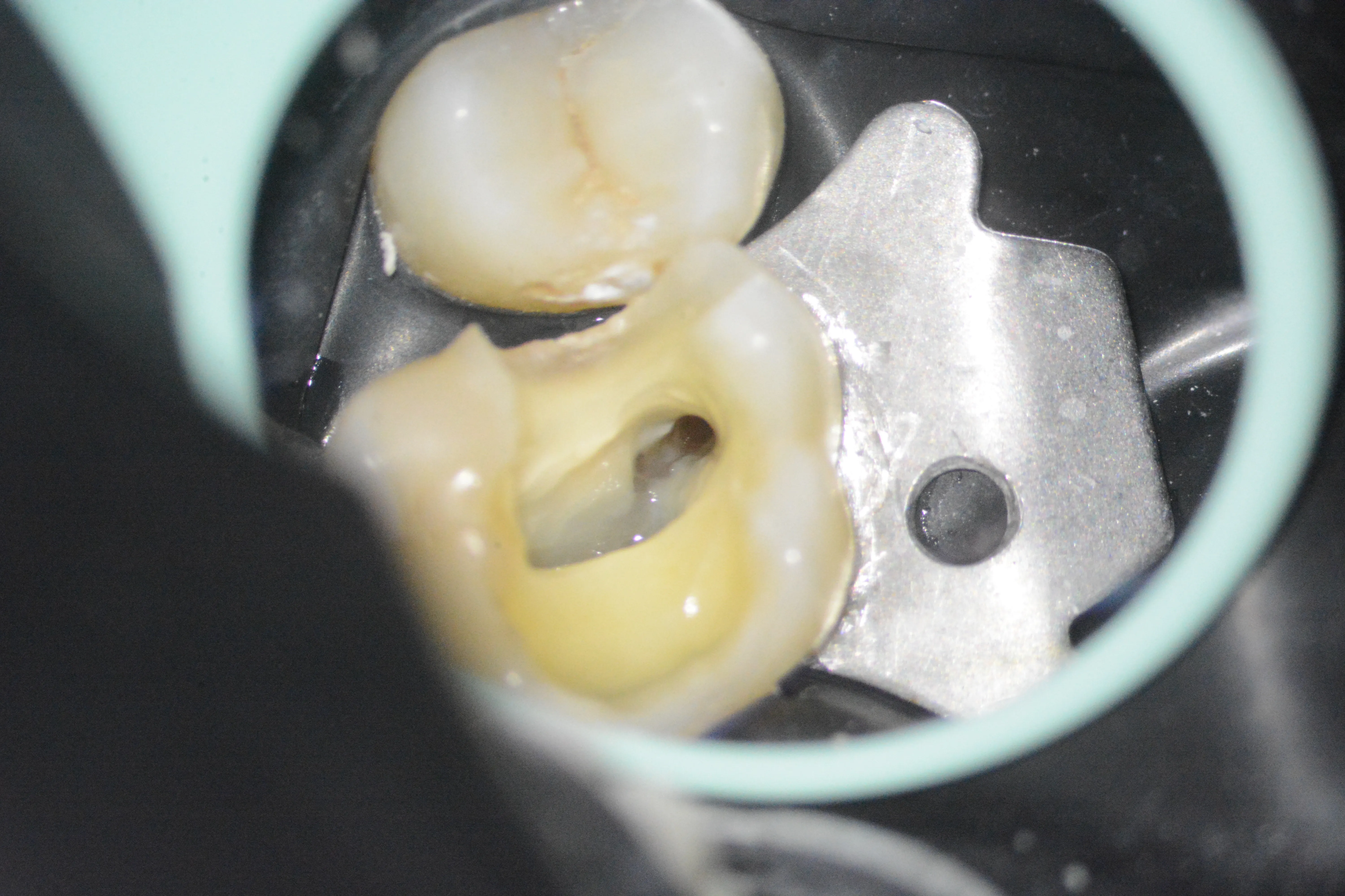 5 – Aspectul sistemului mezial după finalizarea tratamentului mecanico-antiseptic