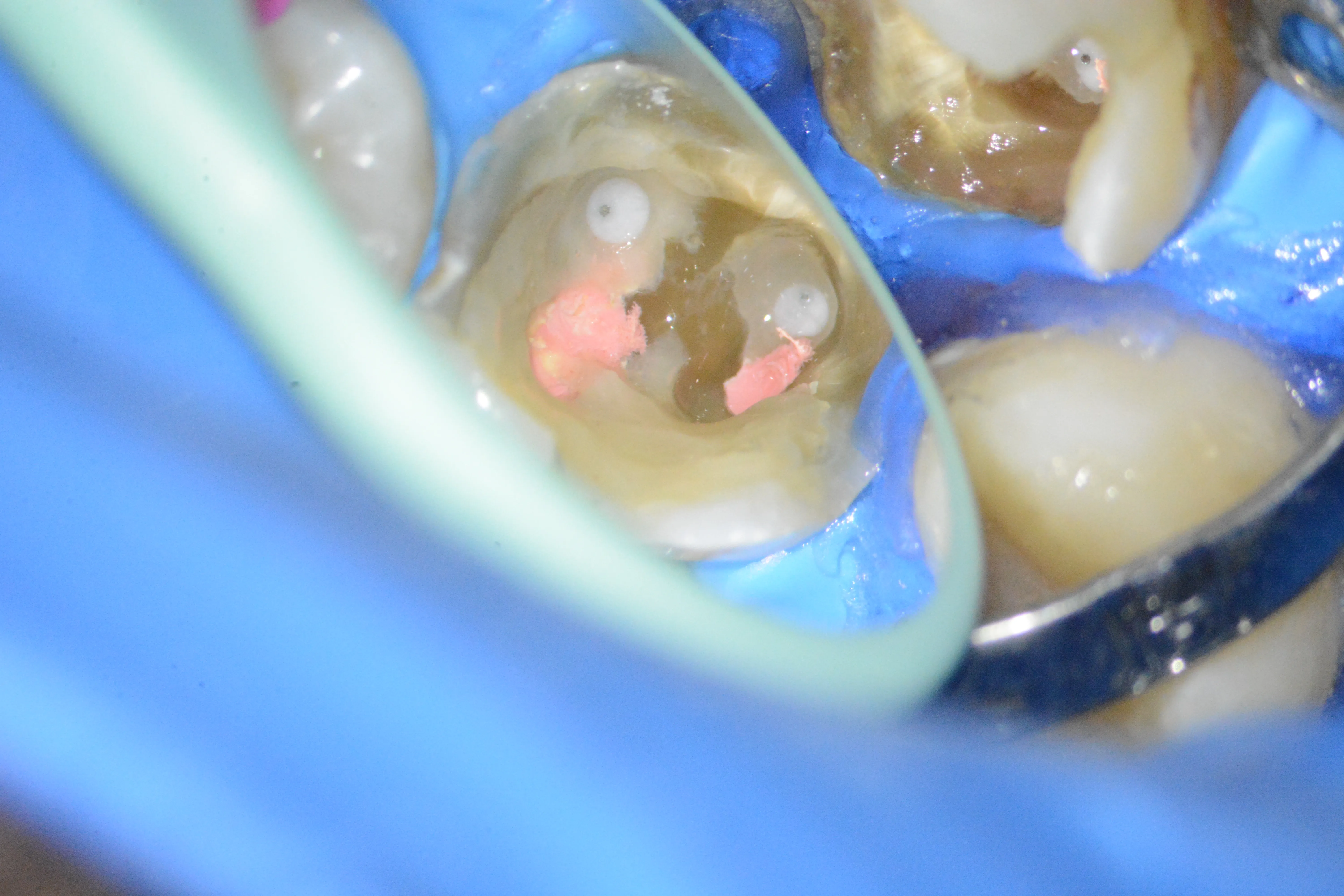 5 – Aspectul clinic al orificiilor canalelor radiculare