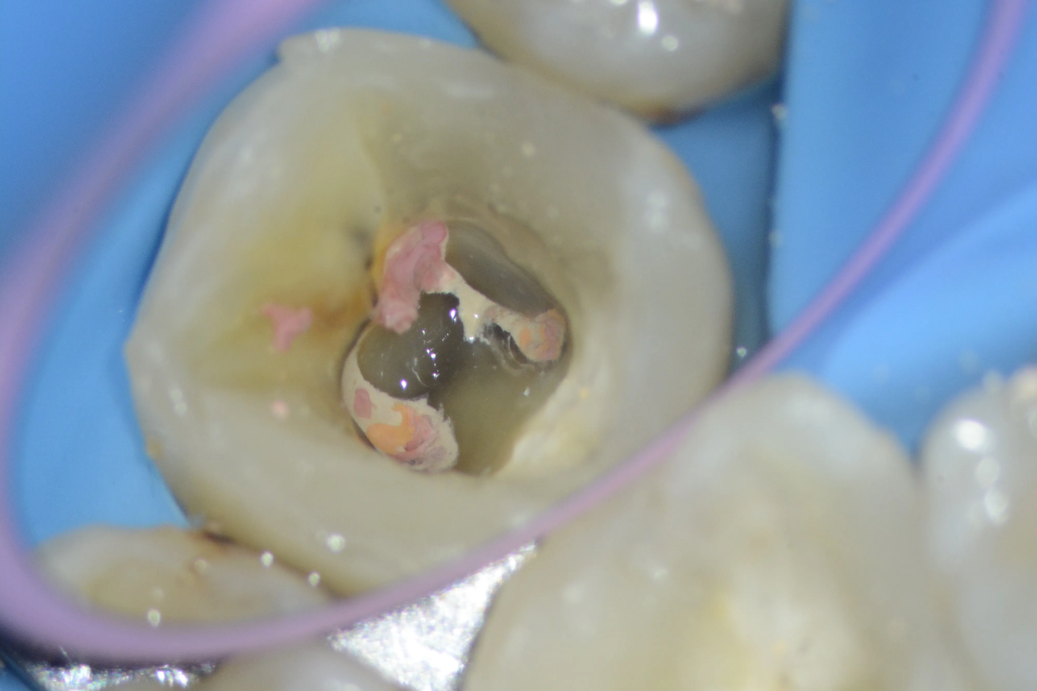 5 - Aspectul tratamentului endodontic anterior