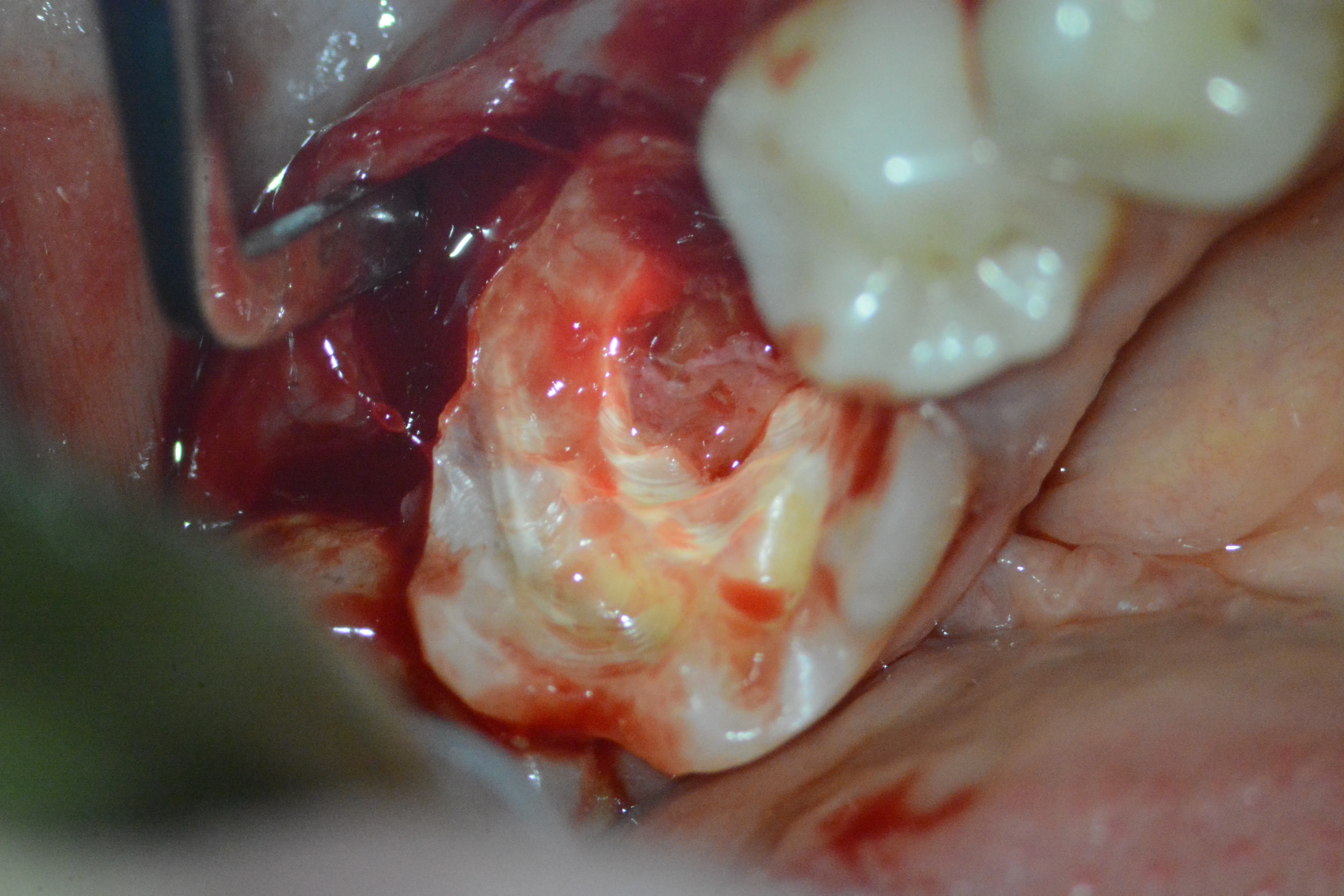 5 – Elongare coronară 