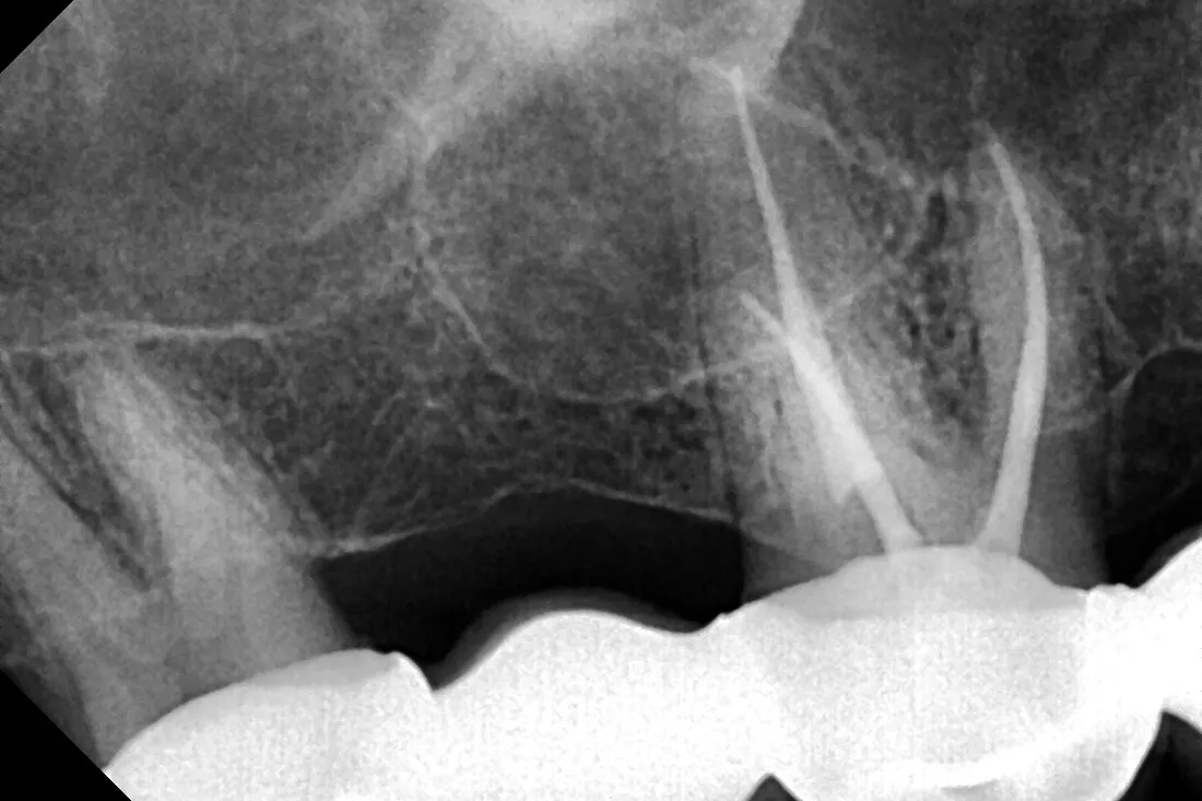 5 - Radiografia de control imediat după finalizarea tratamentului endodontic