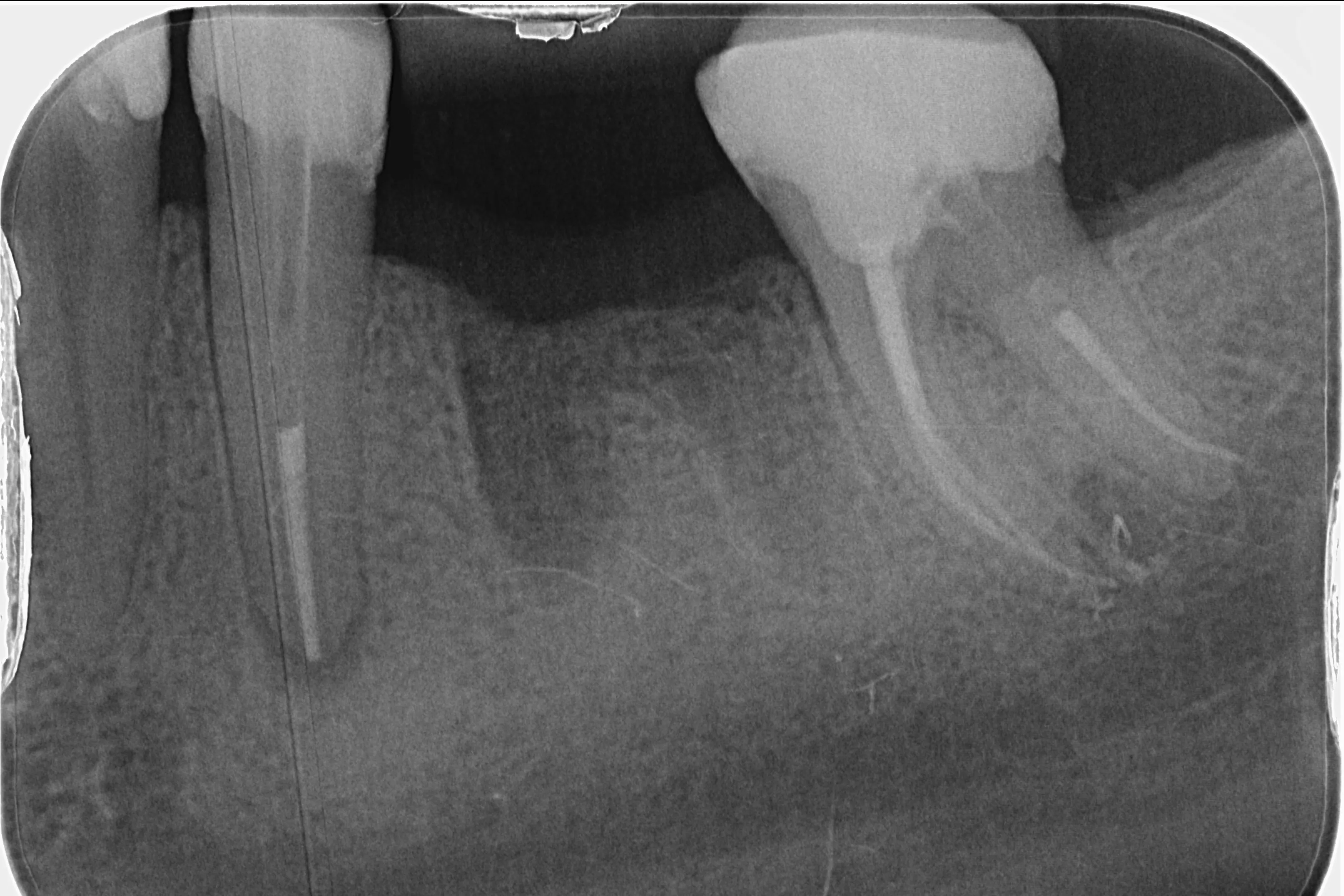 5 - Radiografia de control imediat după finalizarea tratamentelor si reconstrucțiilor corono-radiculare