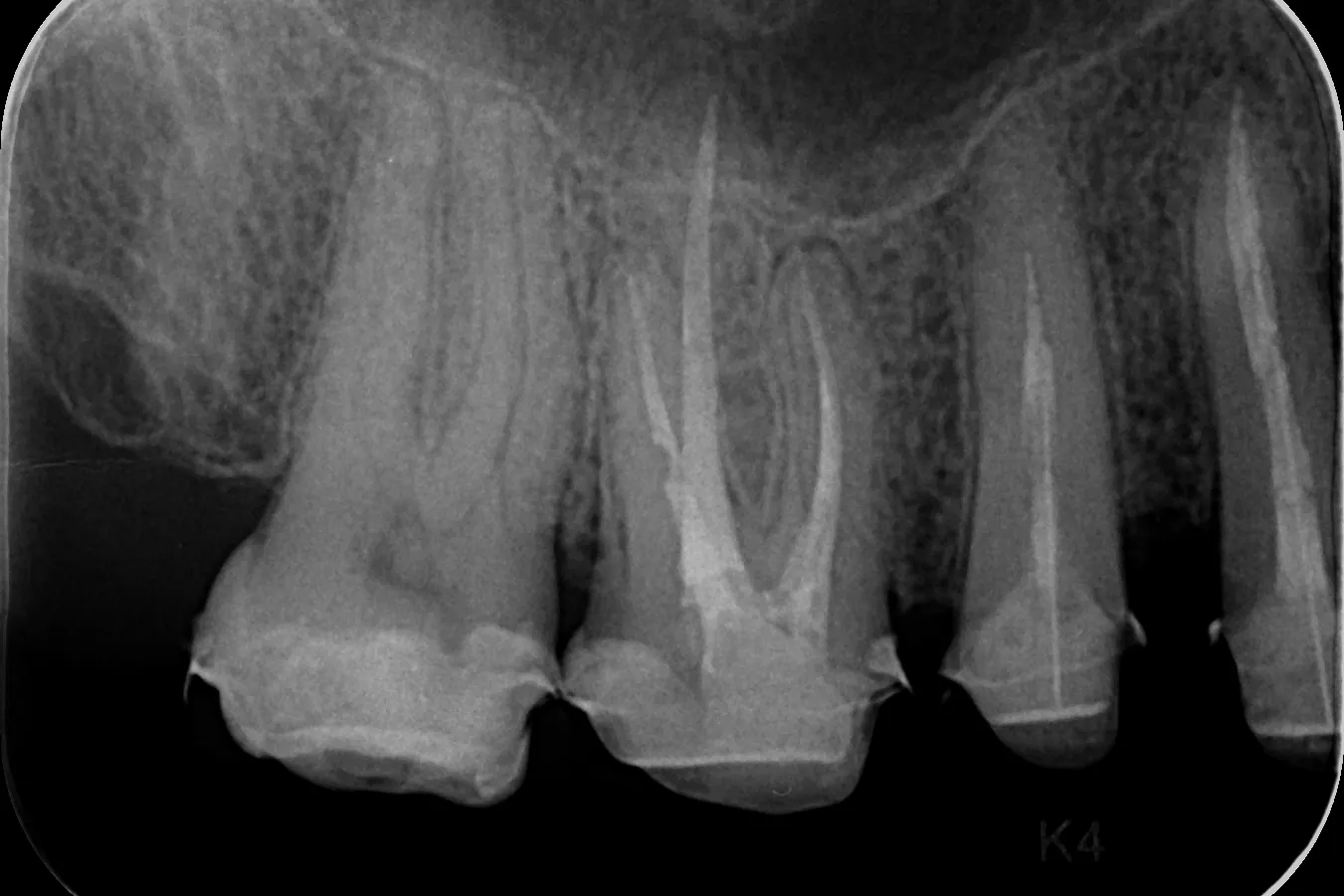 5 - Radiografia de control de la finalul tratamentului endodontic