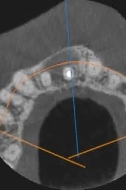 aspectul leziunii la 6 luni de la finalizarea tratamentului endodontic - secțiune axială CBCT