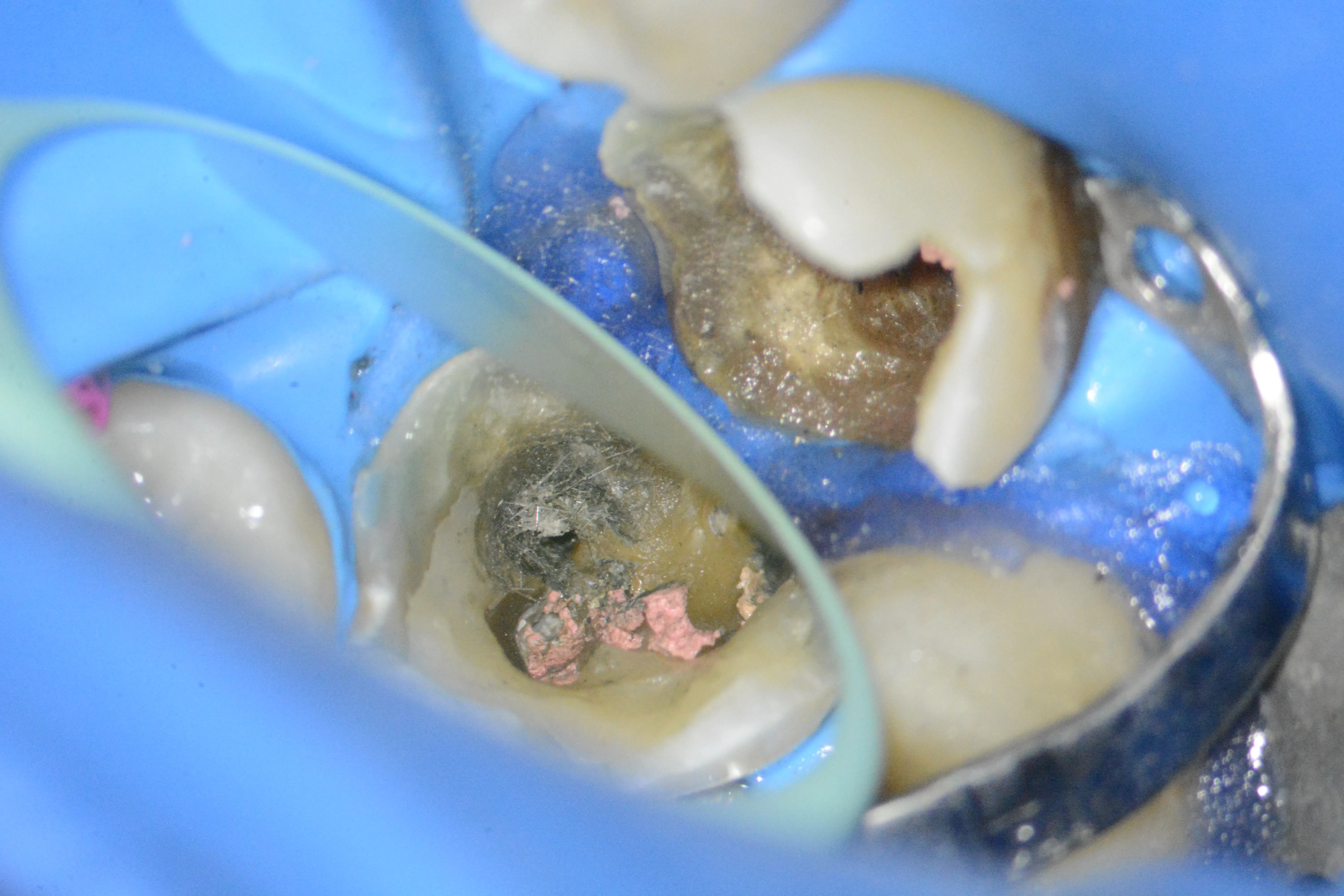 6- Îndepărtarea pivotului de fibră de sticlă din canalul mezial