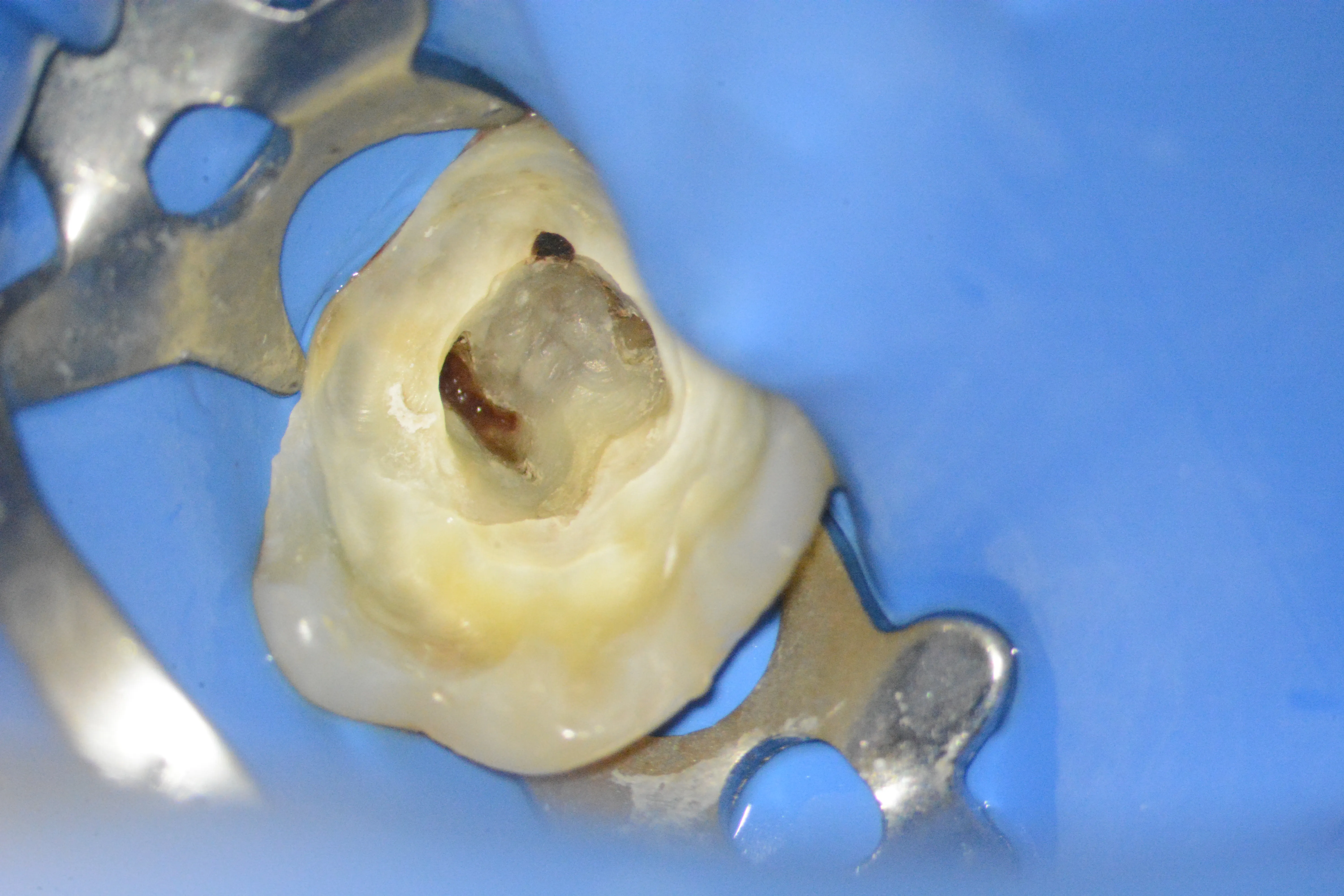 6 – Izolarea după elongarea coronară