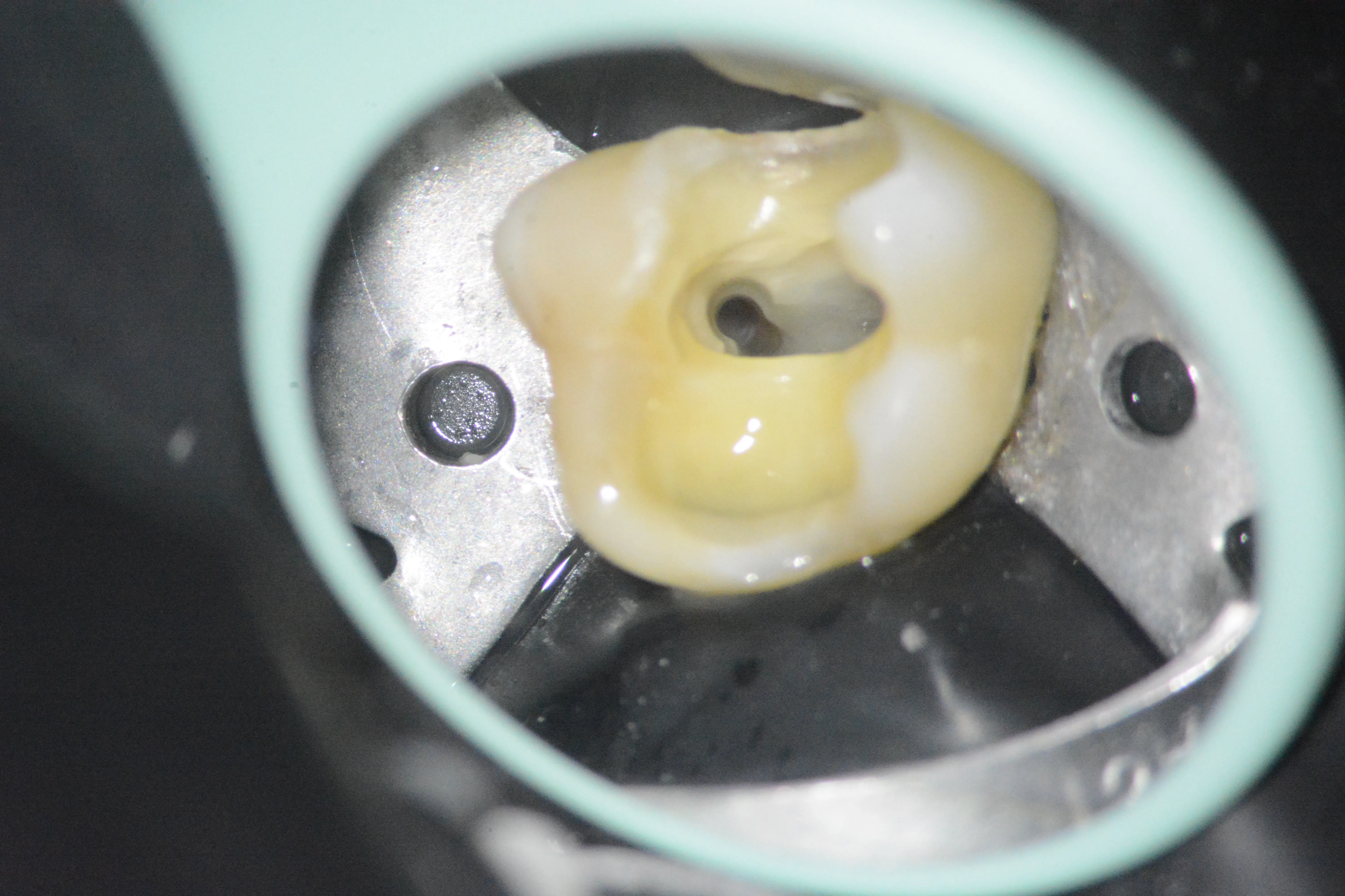 6 - Aspectul canalului palatinal după finalizarea tratamentului mecanico-antiseptic