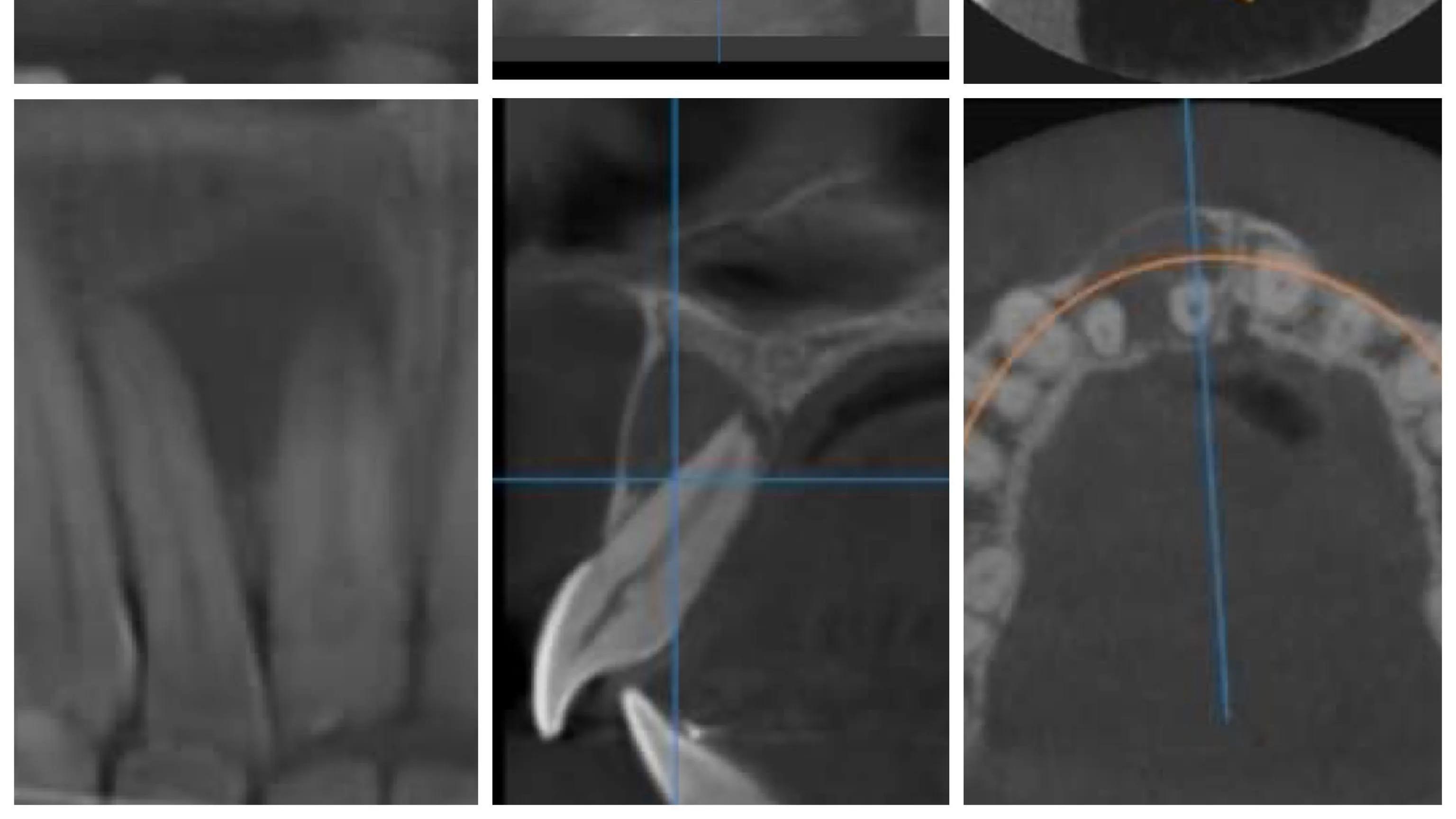 Tratament endodontic incisiv leziune periapicală Cluj-Napoca - evolutie 6 luni