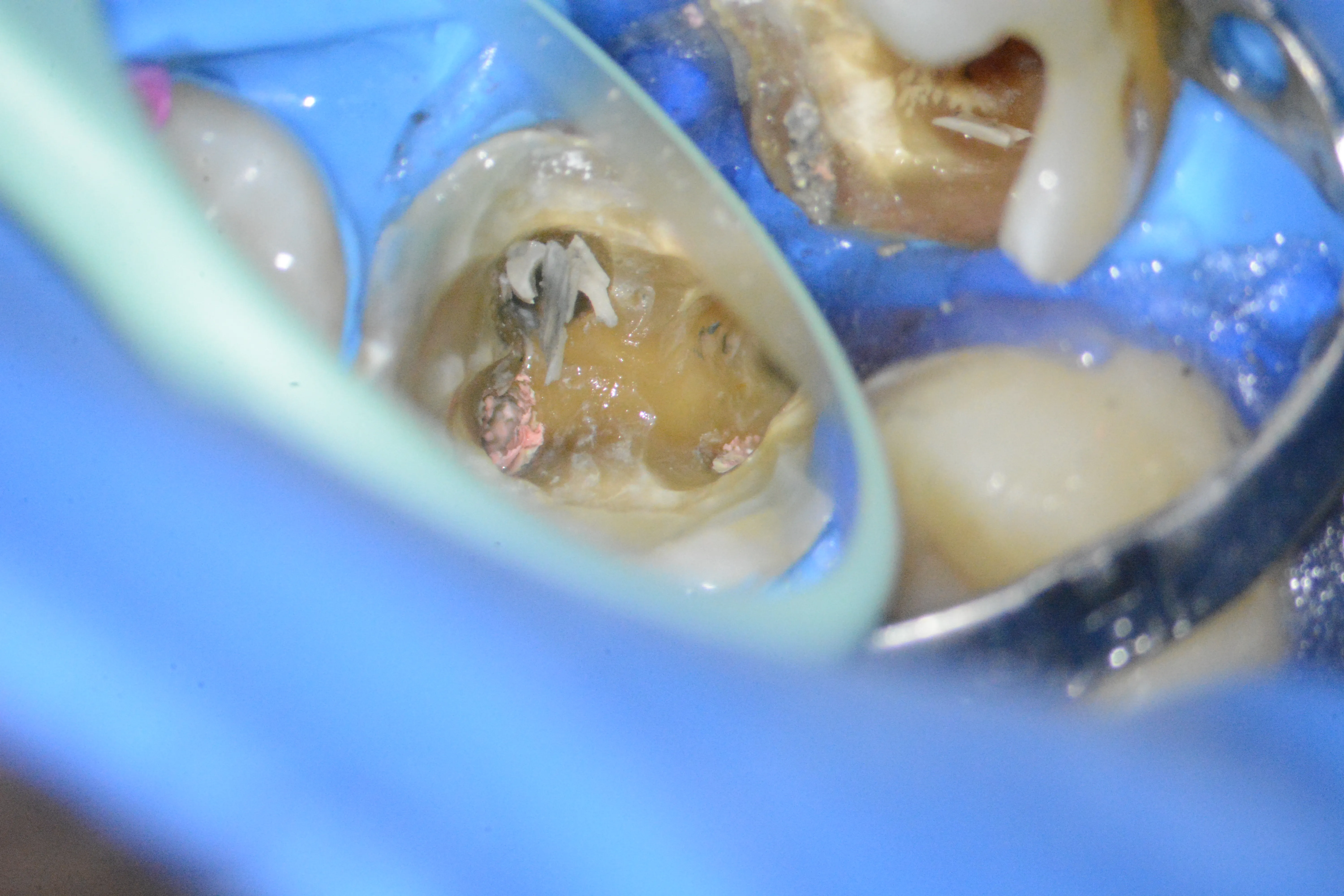 7 – Fragment din pivotul de fibră de sticlă